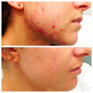 ninofavoriti-trattamento-acne